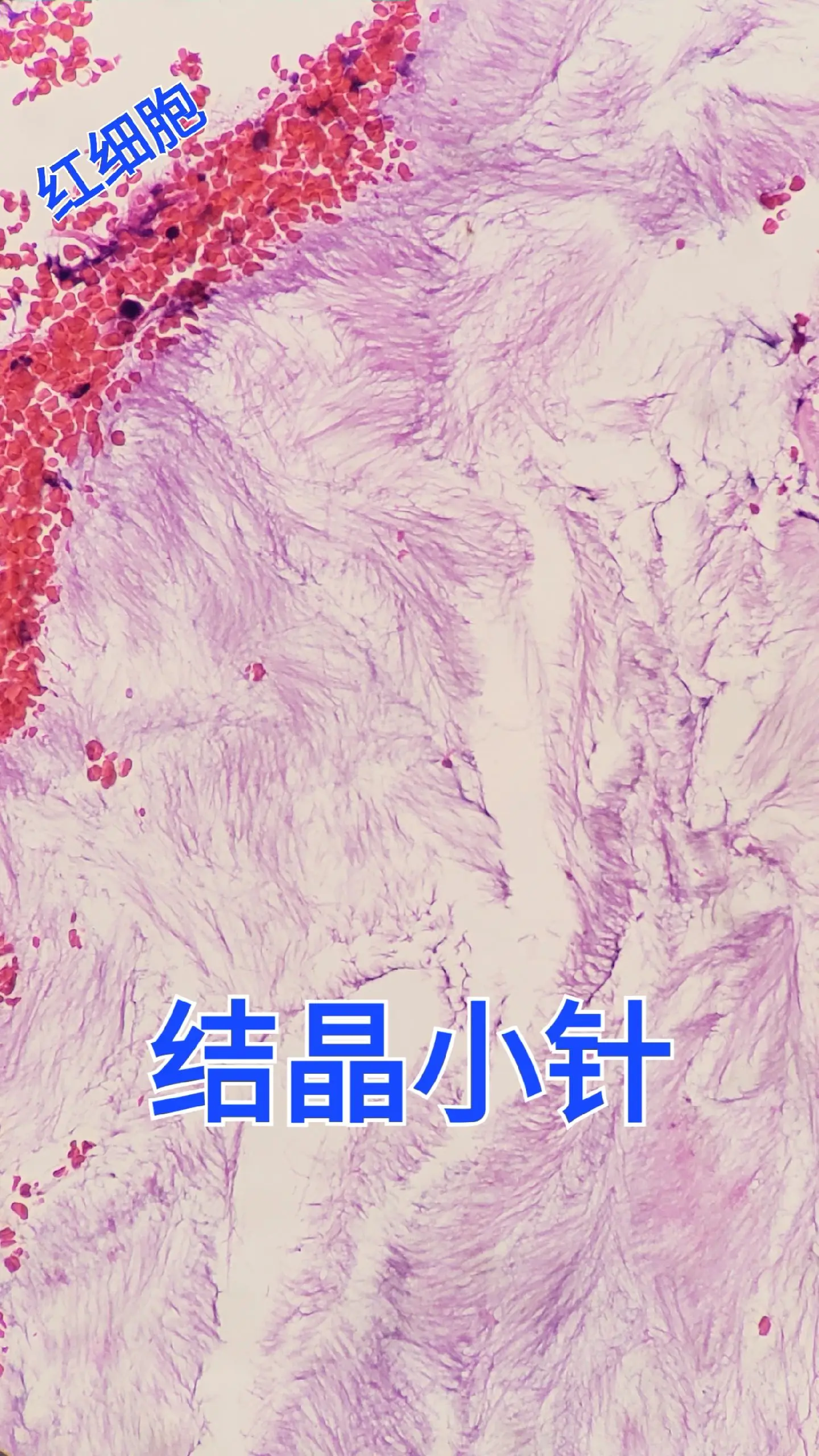 痛风结节  高尿酸痛风