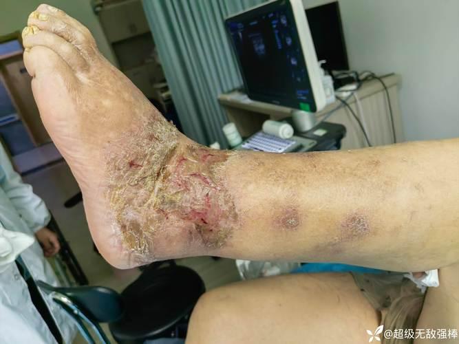 糖尿病并发症咋来的？我用亲身经历跟大伙唠唠
 
哎，以前啊，我是真不知道啥叫糖尿