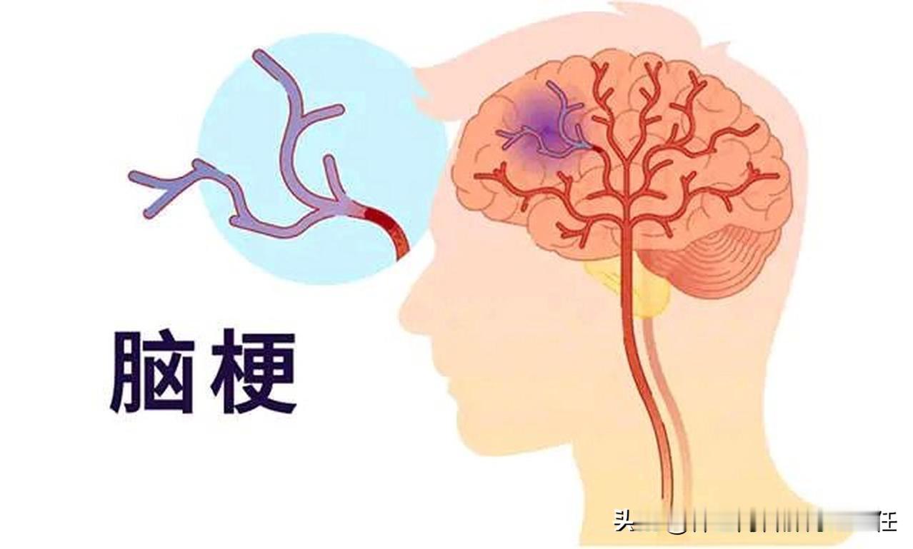 警惕「1 软、2 晕、3 多」！可能是脑梗来临！
 
1 软：为四肢或单侧上下肢