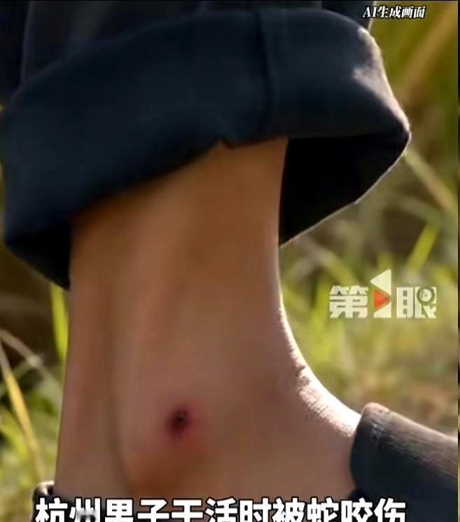 “冲动的代价！”8月30日报道，浙江杭州，一男子干活时，突然感到左小腿一阵剧痛，