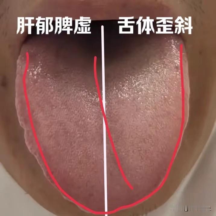 遇见这样的舌象，补脾不是关键，最重要的是通络
昨天有位朋友，他说自己没啥大毛病，