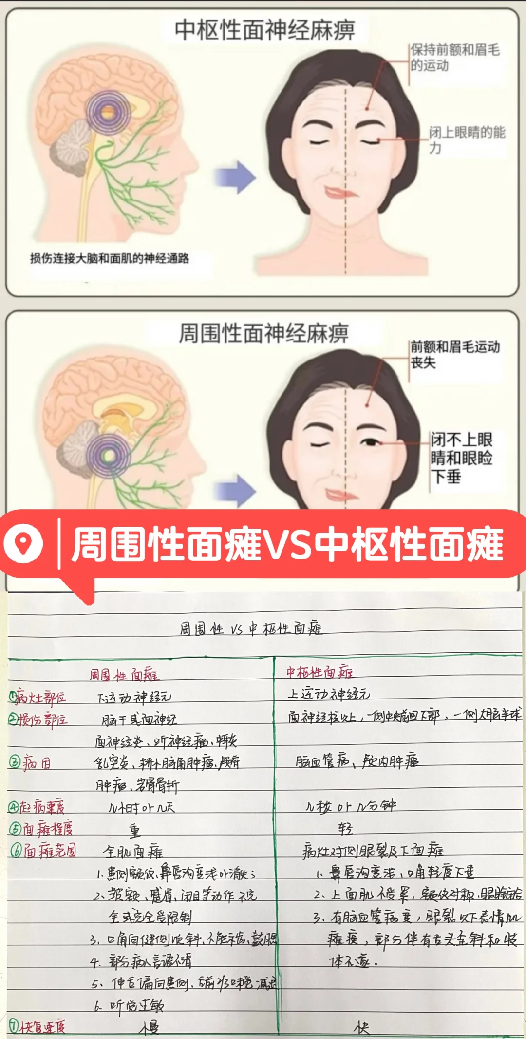 今日分享——中枢性VS周围性面瘫