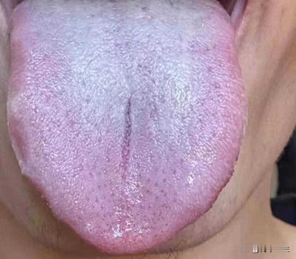 舌苔白茫茫，请注意这可不是脾胃虚寒，你要是去健脾就大错特错了

患者主诉：四肢沉