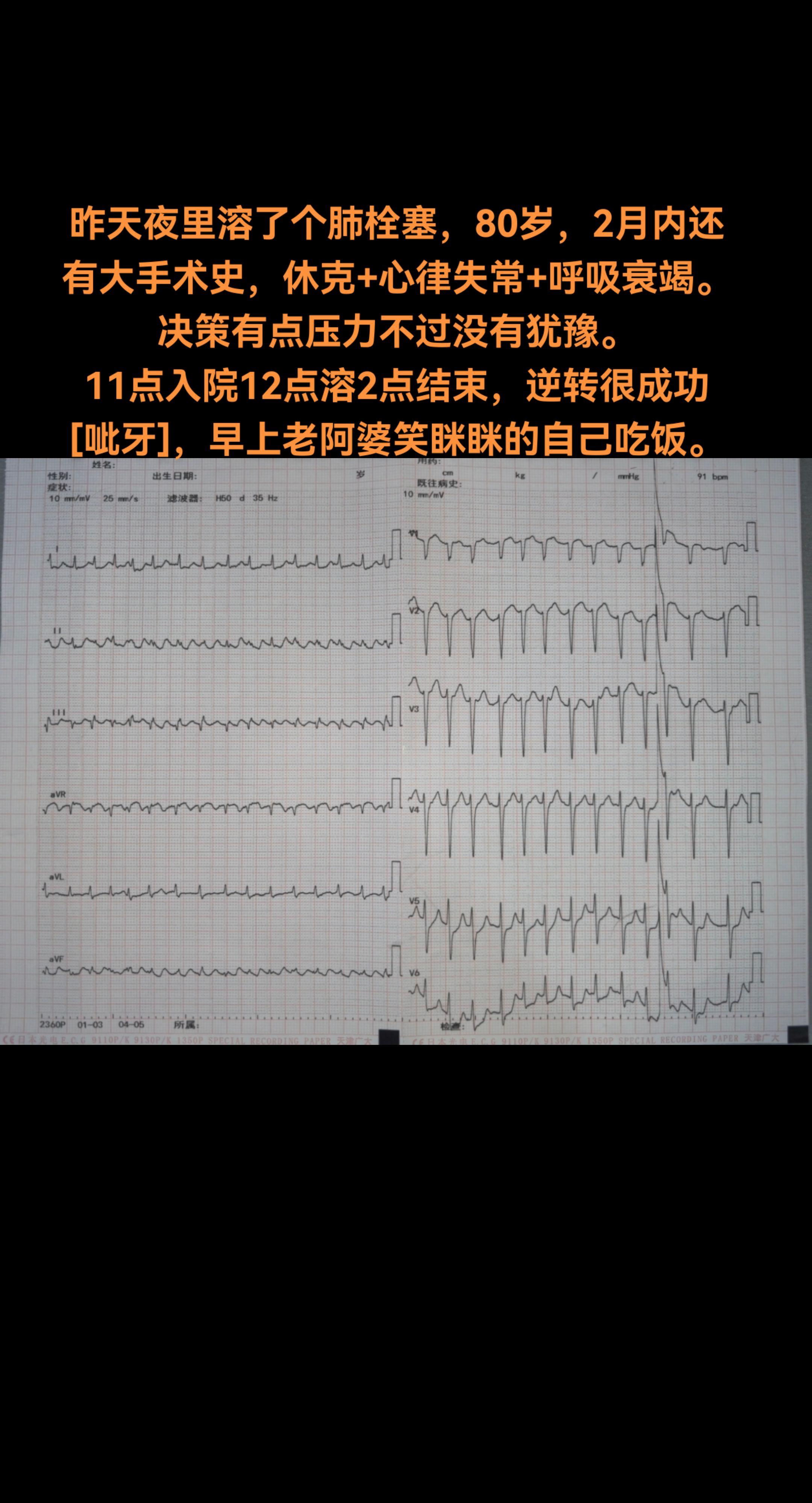 肺栓塞溶栓。