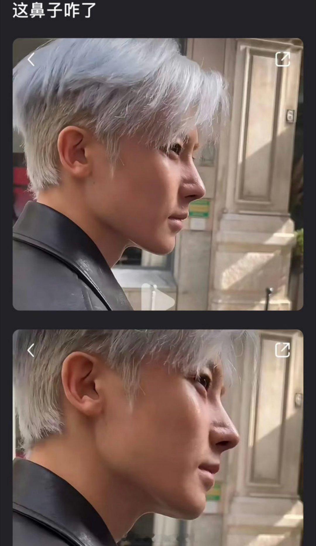 ？侯明昊鼻子怎么回事 