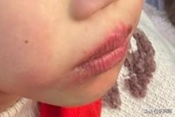 小姑娘的嘴巴都肿成这样了，还在吃零食，不疼吗？

早晨在公交车站等车
走过来一对