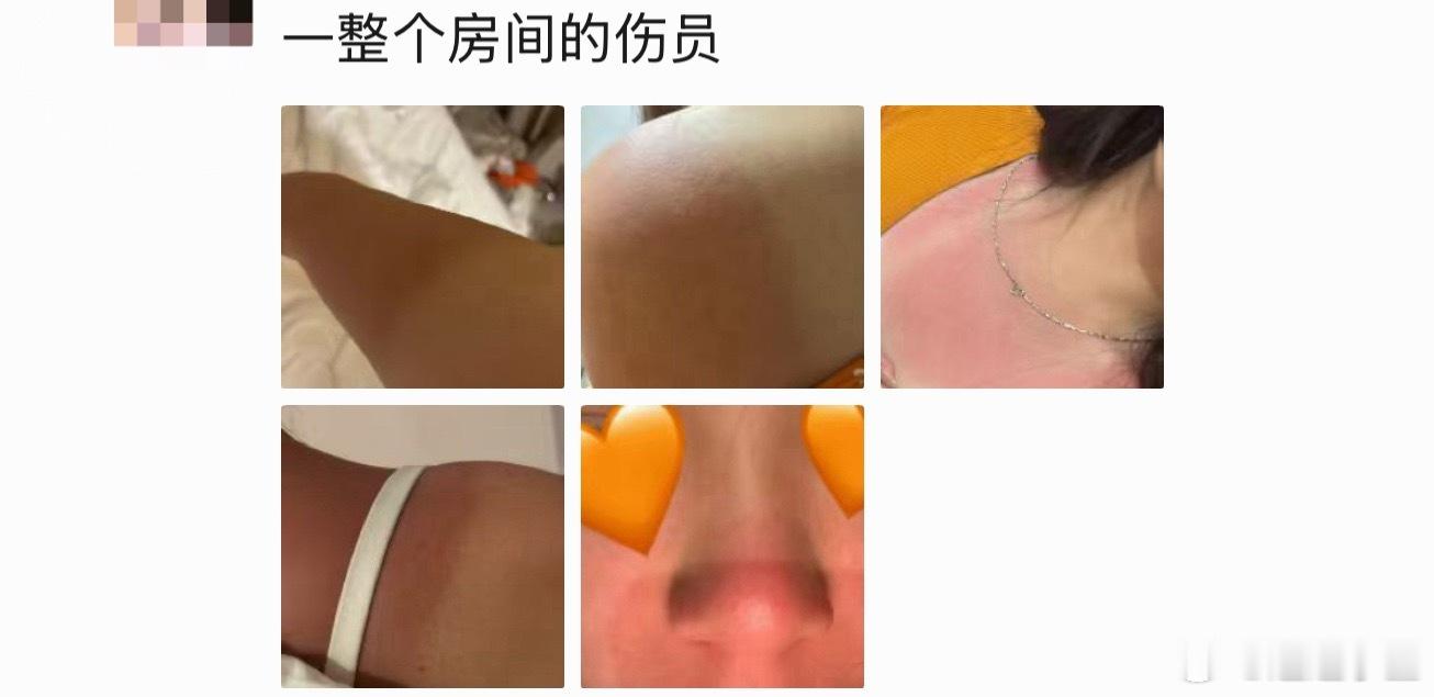 最近天气炎热 大家真的很辛苦 可以看看我刷puq看到的极丝被晒伤的状态 只希望不