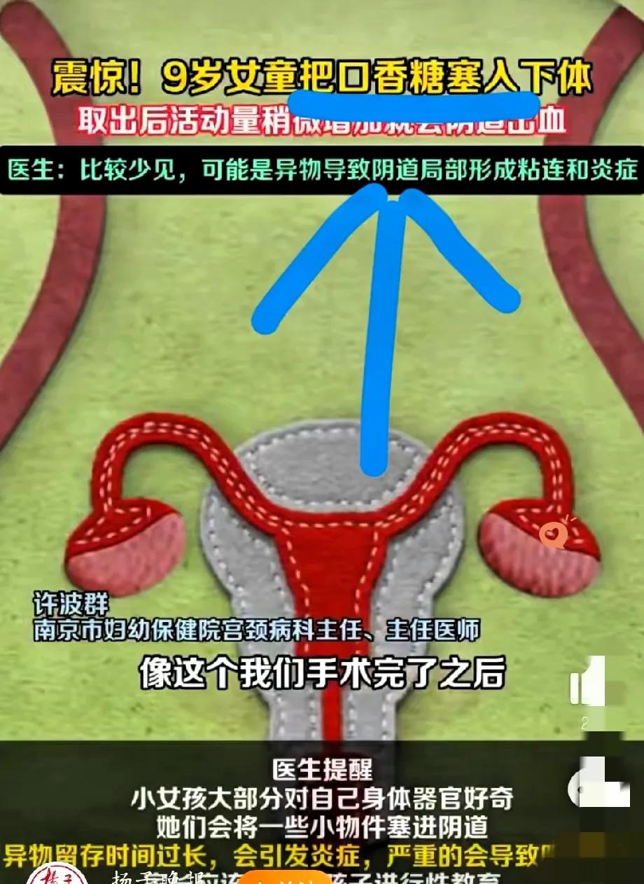 “江苏9岁女孩把嚼过的口香糖塞进阴道，最后要两次手术！这事儿看完，真得喊一句：性