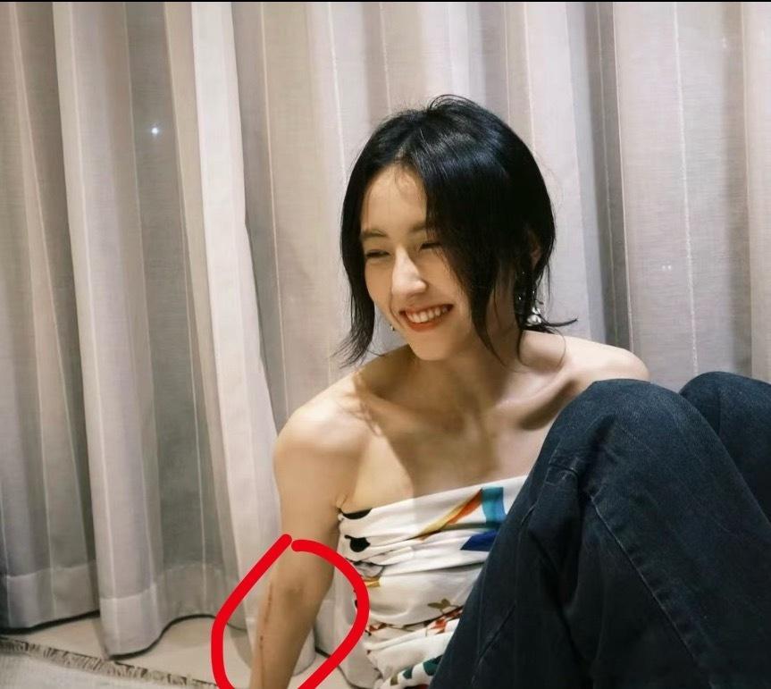 张子枫手臂上的伤.疤，据说是她在《我们生活在南京》剧组拍戏时意外划.伤的。伤口都