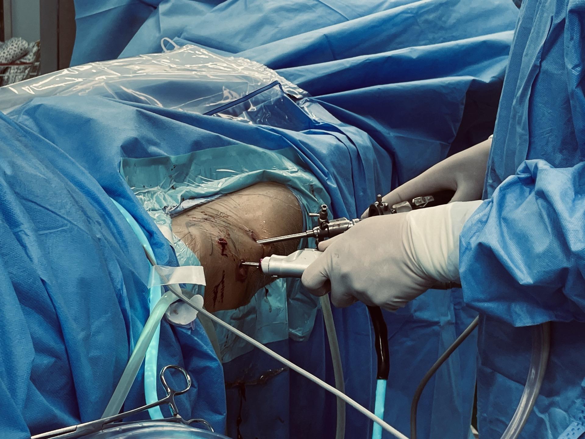 髋关节镜下游离体取出。髋关节脱位，股骨头圆韧带撕脱性骨折，髋关节镜下取...