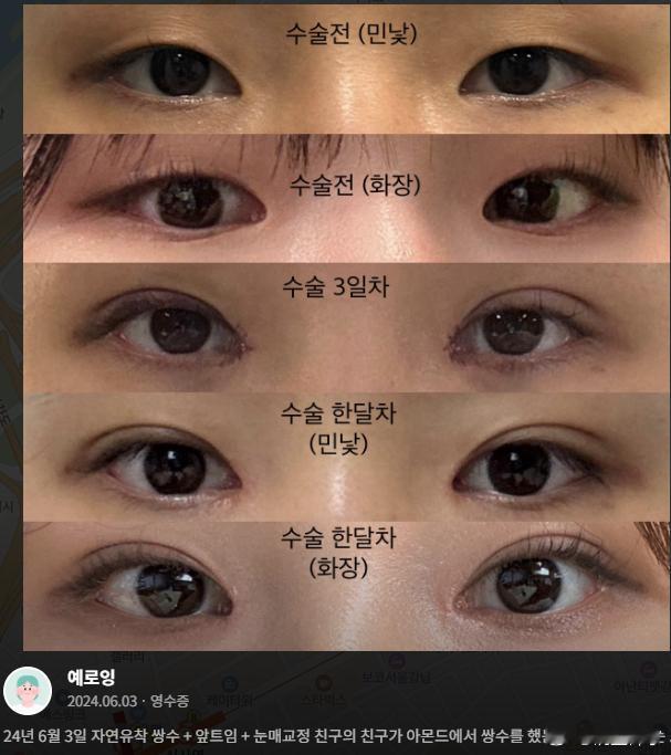妈妈带着初中生女儿做了双眼皮