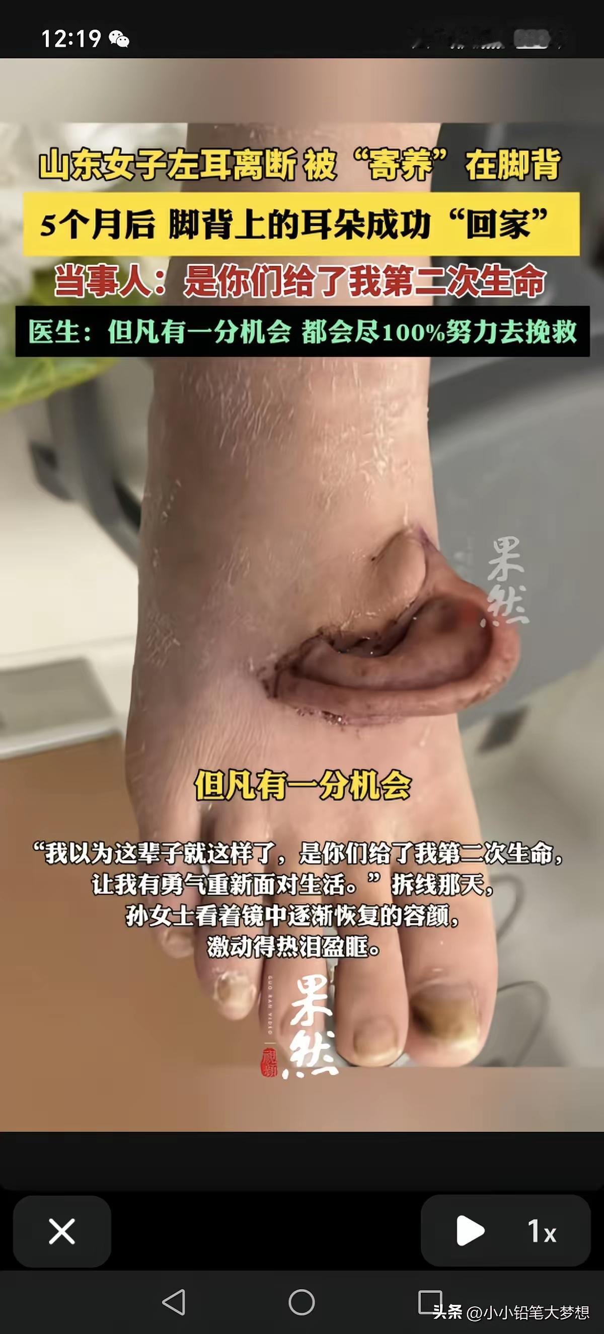 左耳长在脚背上？整整5个月！这听起来像科幻片的情节，居然是真实发生的事！
 
刷