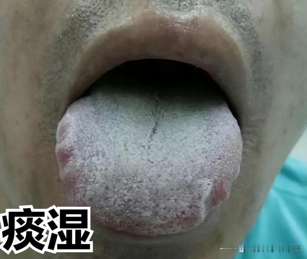痰湿用二陈，肝胆湿热用龙胆泻肝汤；寒湿用桂附地黄，教你通过舌象把身体里的湿拔干
