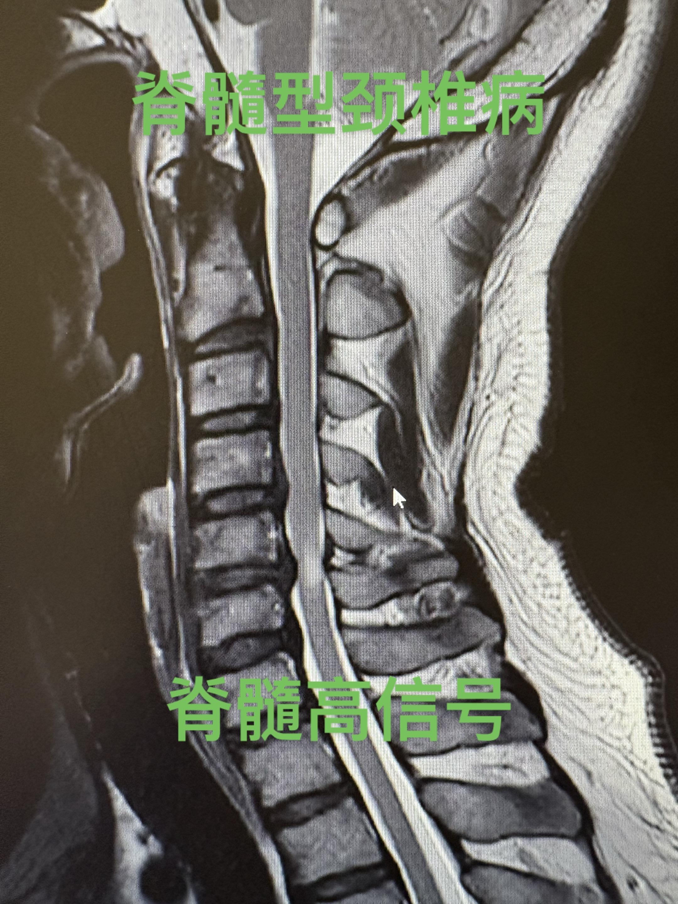 颈椎病手术后后一年复查。手术做完一年，患者手术前的踩棉花感已经消失，但...