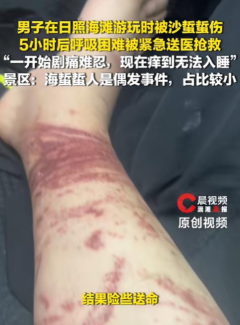 “瞧这事儿闹的！”近日，山东日照，一外地游客到海边景区游玩，结果不小心被海蜇给蜇