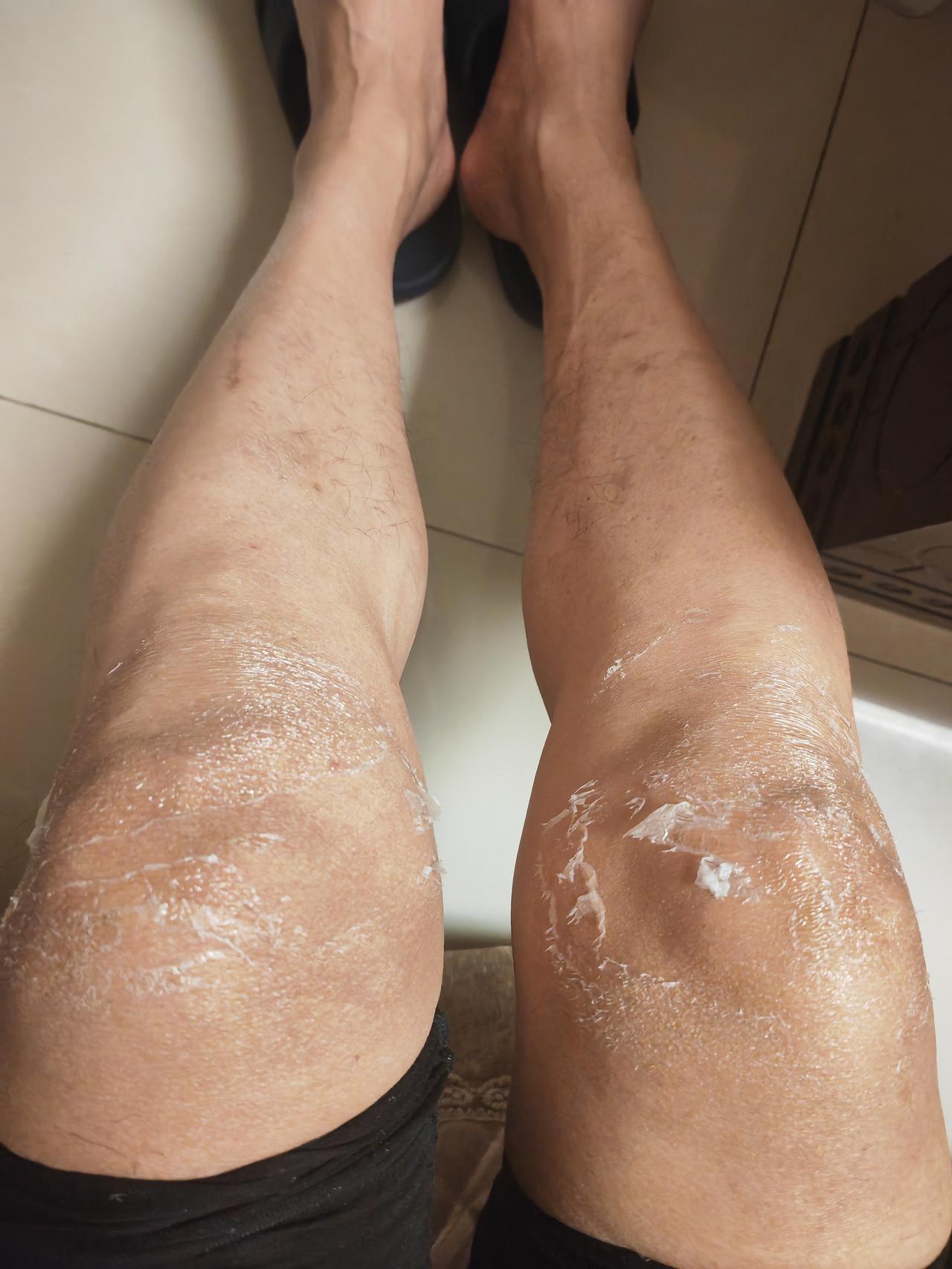 膝盖疼，买的一种凝胶涂抹，一天两次，一点点效果没有。第一次用这个药，不懂它的原理