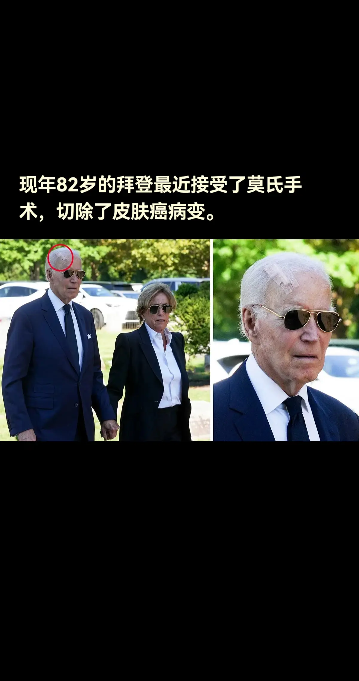 现年82岁的拜登最近接受了莫氏手术，切除了皮肤癌病变。  此前，有人看...