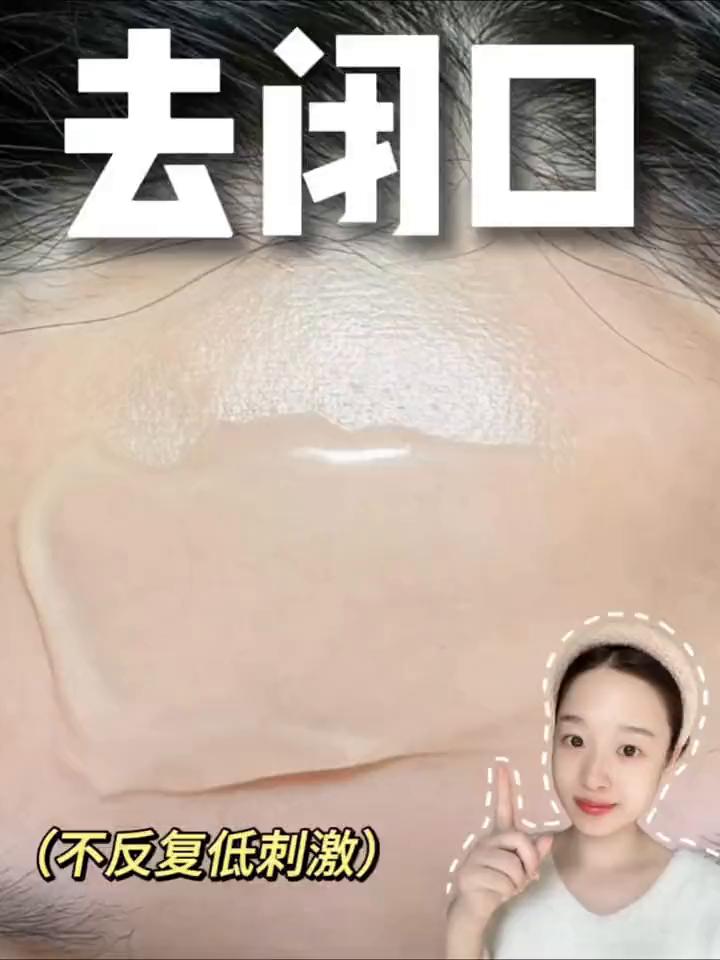 快速版去闭口干脸，人人都能去掉陈年闭口。
·第一步：用热毛巾热敷全脸，敷到毛巾变