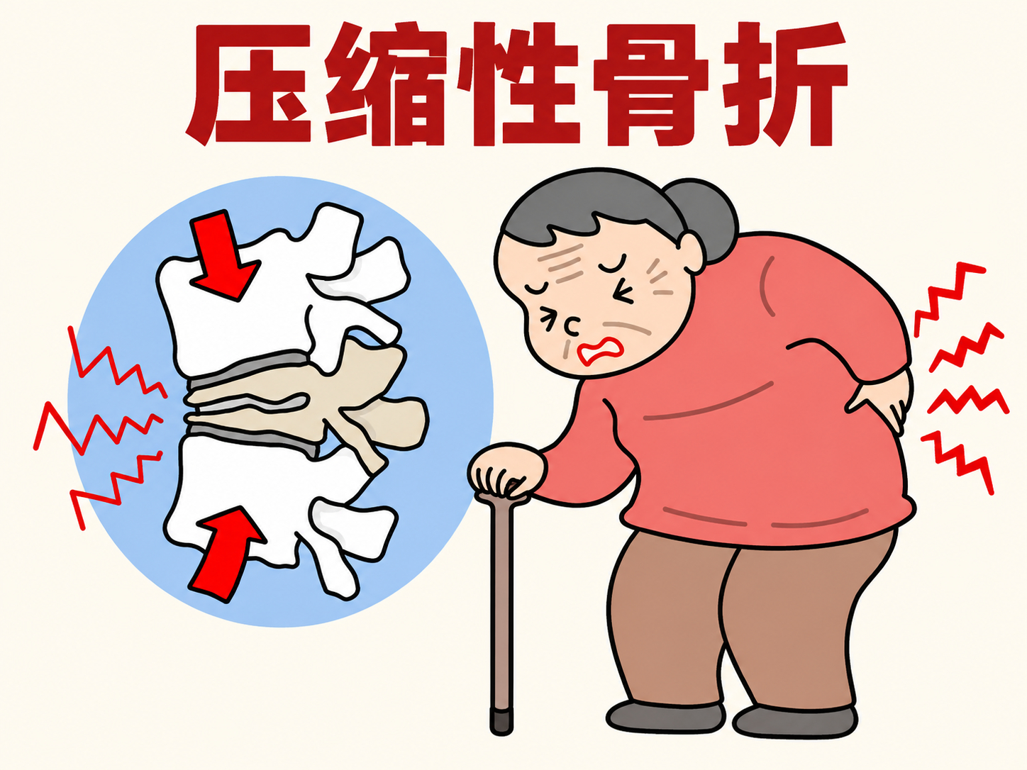 一次弯腰也可能压缩骨折 有些老人只是弯腰捡东西，甚至咳嗽一下，背部突然像被刀劈一