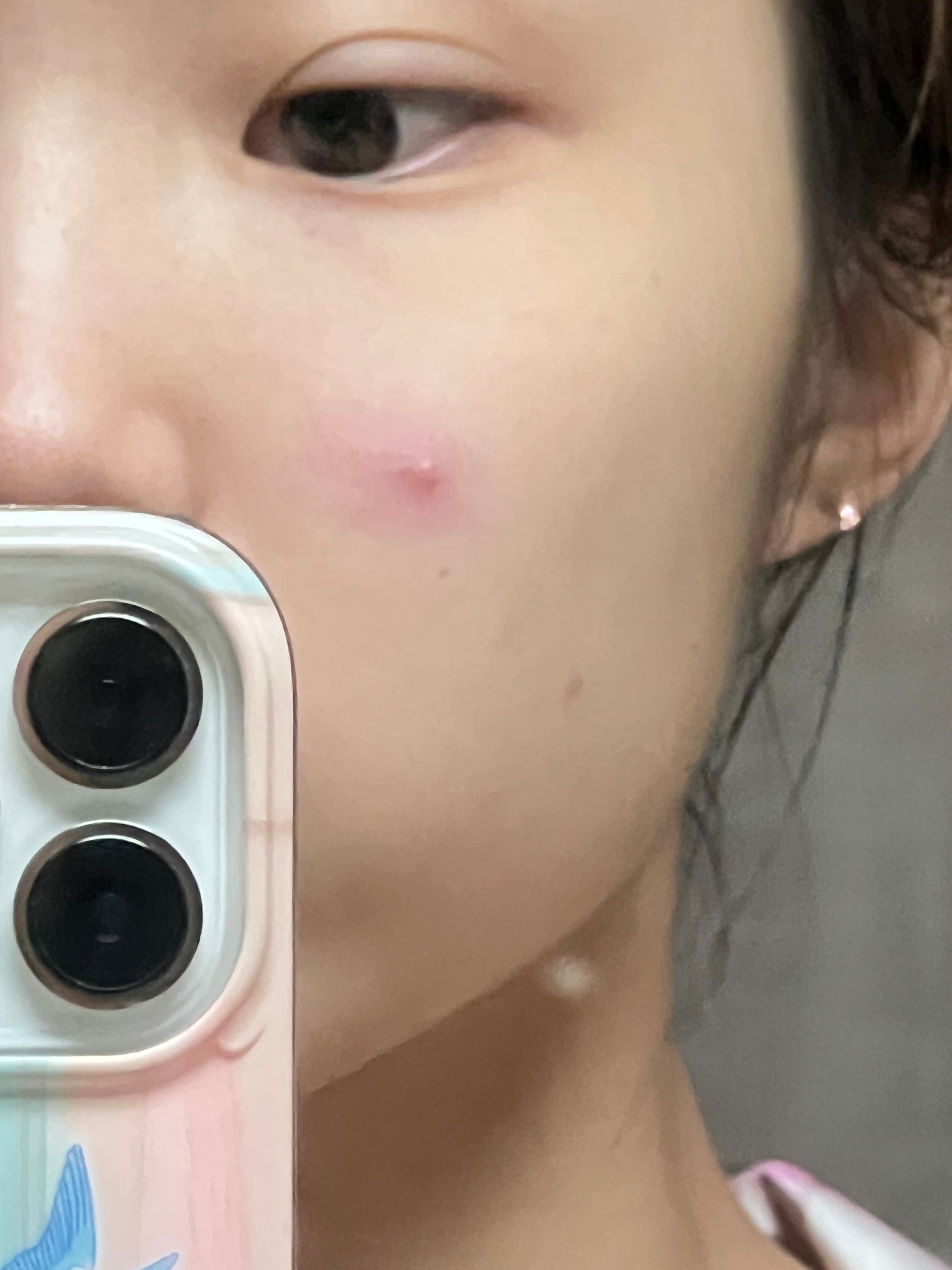 不记得上次长这么大的痘痘是啥时候了给它点上一颗痣伪装1下… ​​​