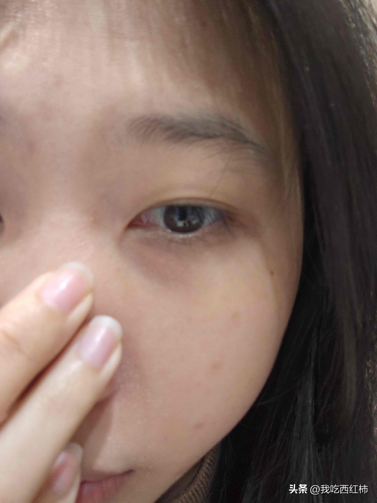 被黑眼圈困扰快10年了，还有救吗？😭
01 年的，黑眼圈从初中就焊在脸上了
眼