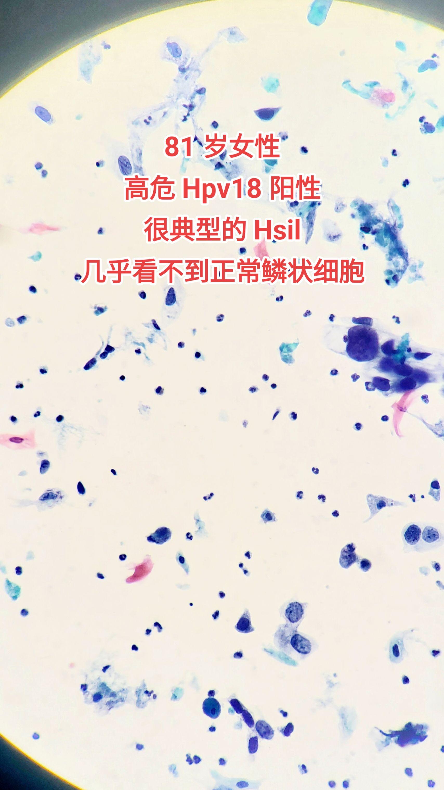 hpv感染 HSIL