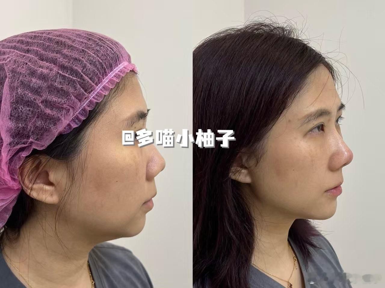 忍不住要分享一下，三胎生完感觉松弛了好多，我去do脸了，听完医生的面诊方案以后，