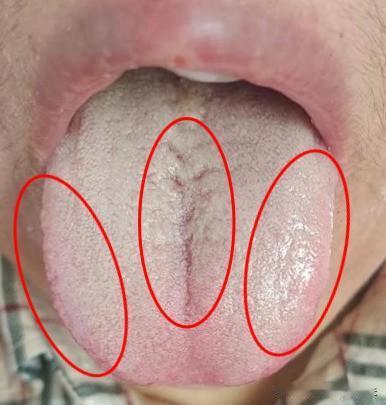 舌苔厚腻，痰湿困脾，送你两个中成药，疏肝健脾，通达一身气机
平时呢，总是容易感到