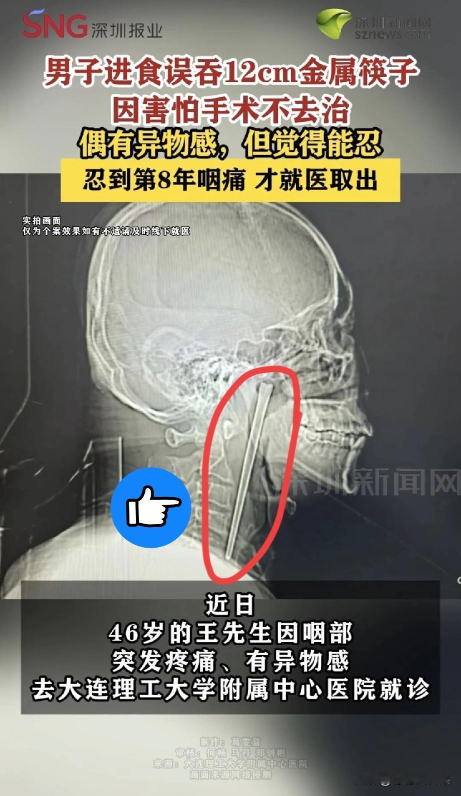 现实版的忍者神龟，12cm金属筷子在喉咙里“住”了8年？！
 
家人们谁懂啊！大