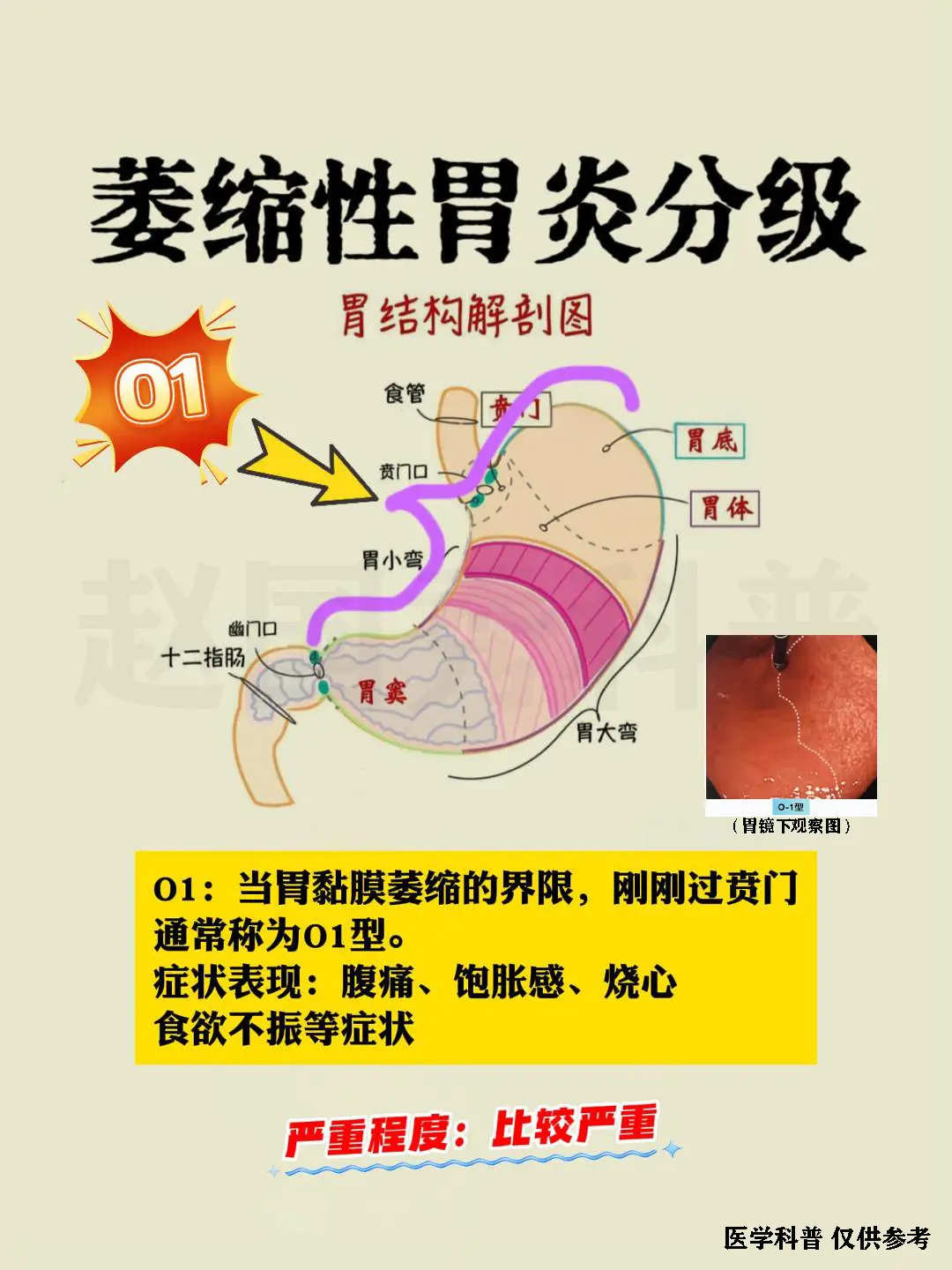 萎缩性胃炎 胃病 中医 健康