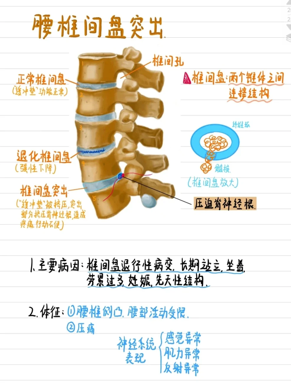 医学生笔记-腰椎间盘突出