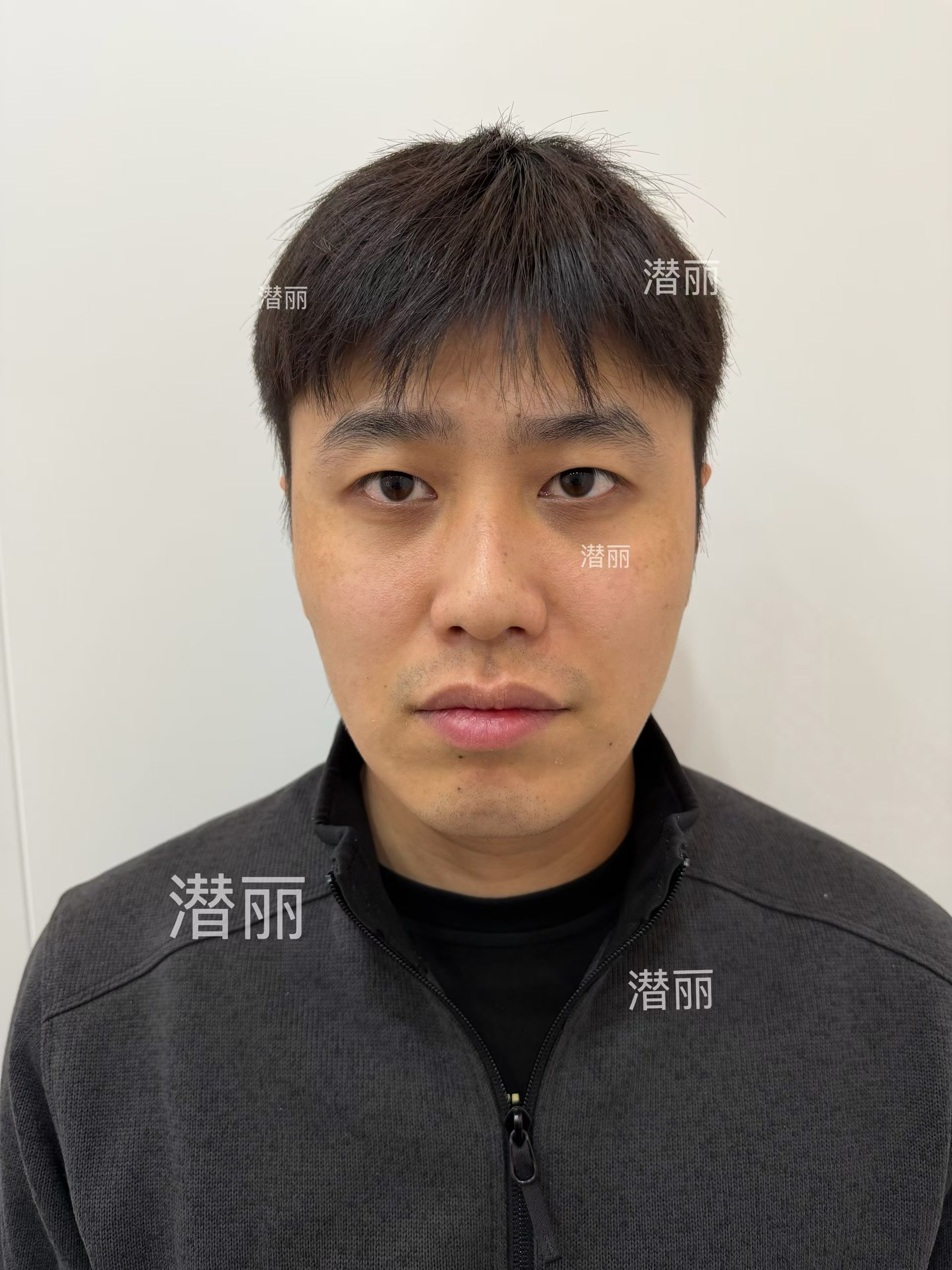 实不相瞒 万宁叔跟小吴是同一个大白操刀的有需要我可以免费推荐万宁叔整容