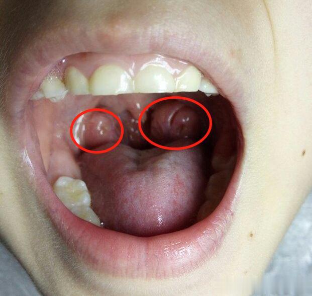 孩子腺样体肥大，必须要手术？不一定，中药辨证施治，标本兼治
 
中医治疗腺样体肥