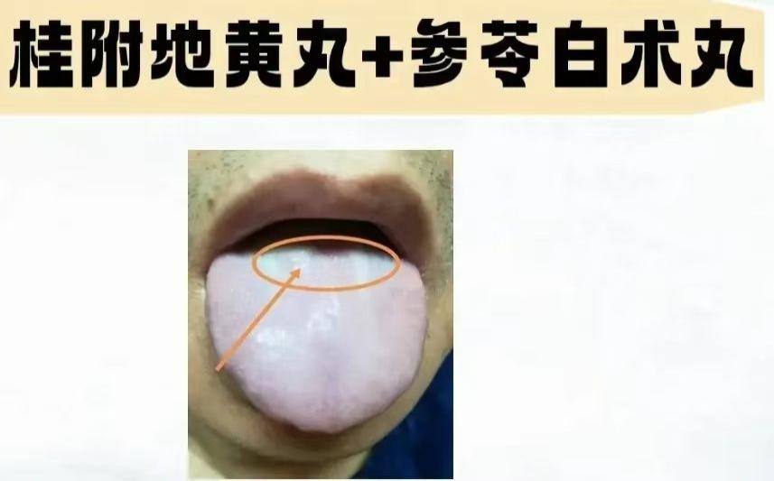 桂附地黄丸这样用，不仅能健脾阳、补肾阳，还能清除体内90%的痰湿！

1.桂附地