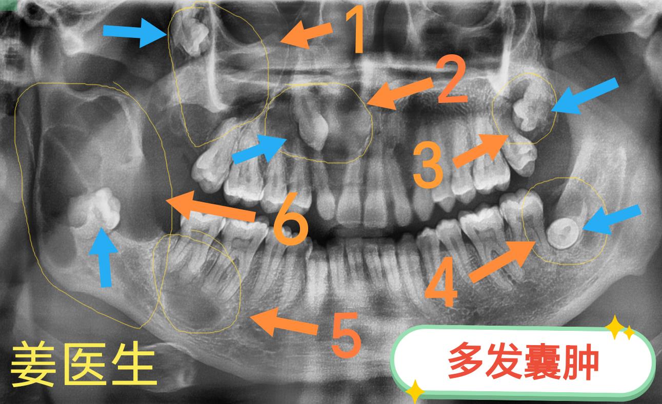 局麻下 多发性囊肿刮治（上颌）局麻下行 “上颌3个囊肿刮治+拔除3颗埋...