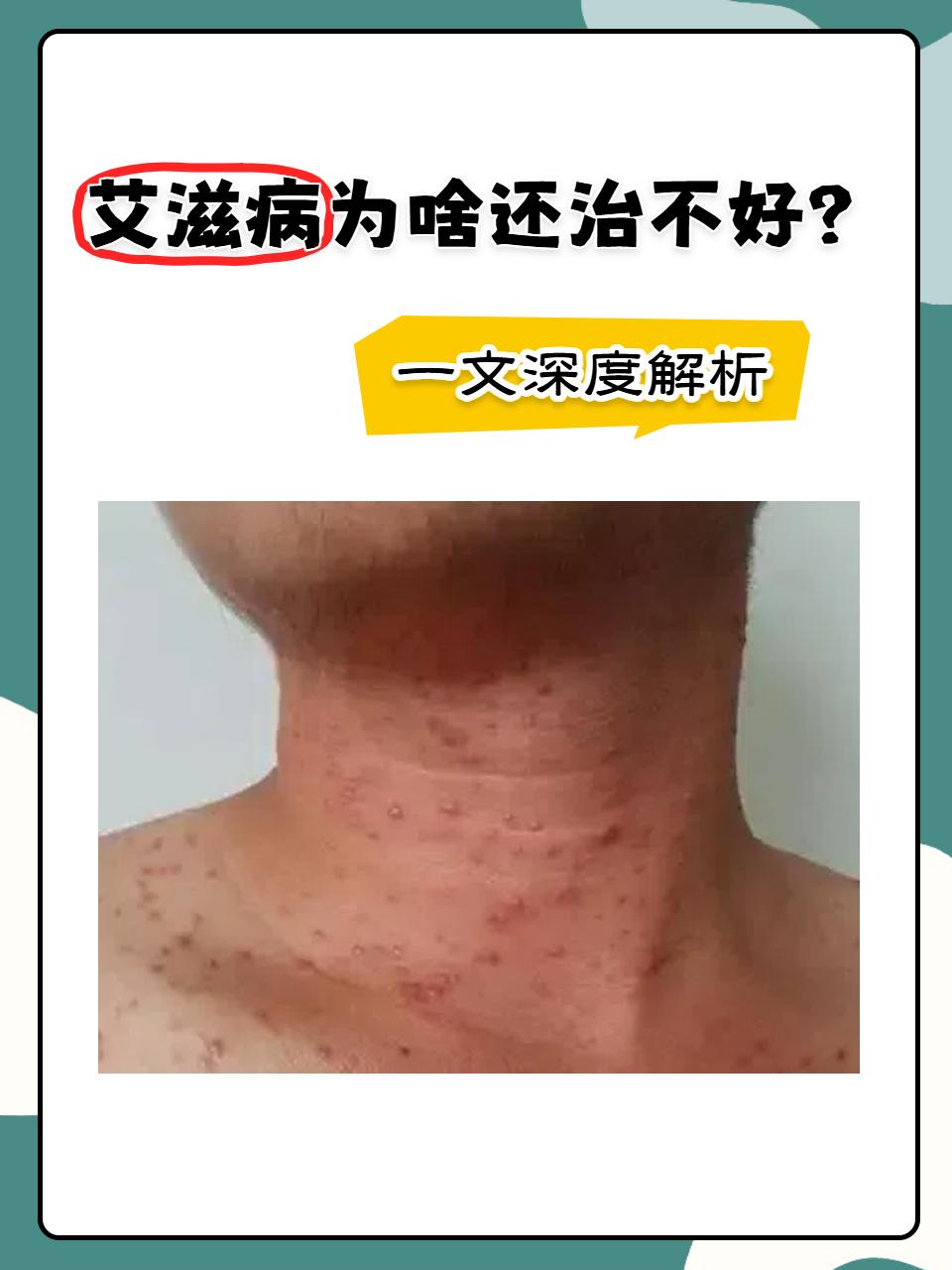 去年全球艾滋病防治多项指标创新低，这乍一听是个好消息。2025年新增艾滋病病毒感