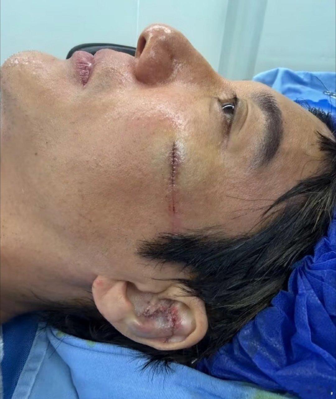 王力宏缝了39针王力宏真的好敬业啊，昨天一边流血一边唱歌，熬到演唱会结束缝了39