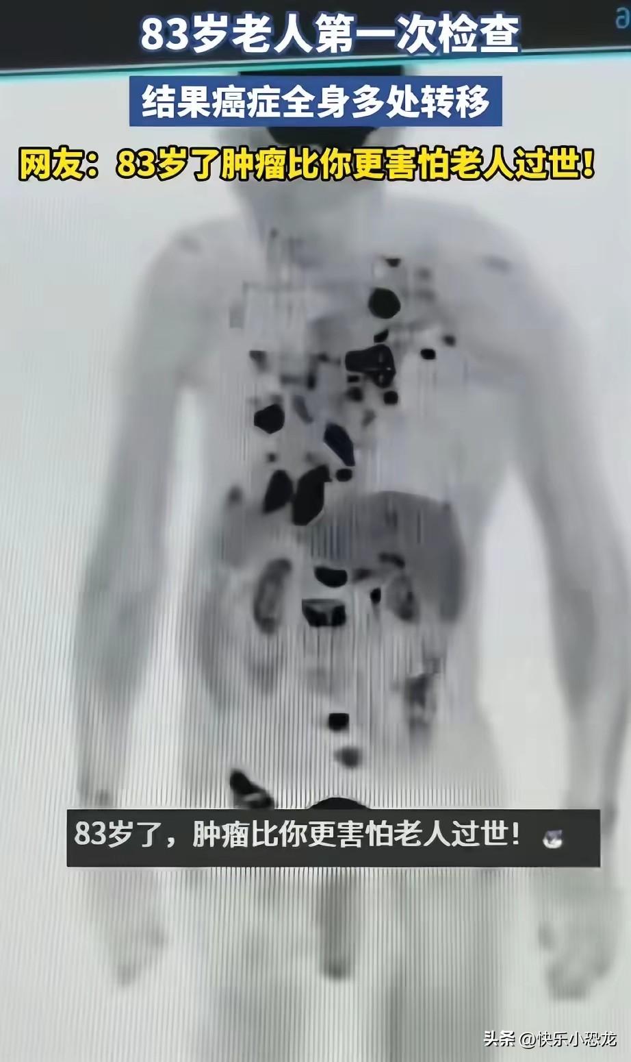 不可思议！安徽一位83岁老人，生平第一次做全身检查，结果片子显示癌细胞已全身转移