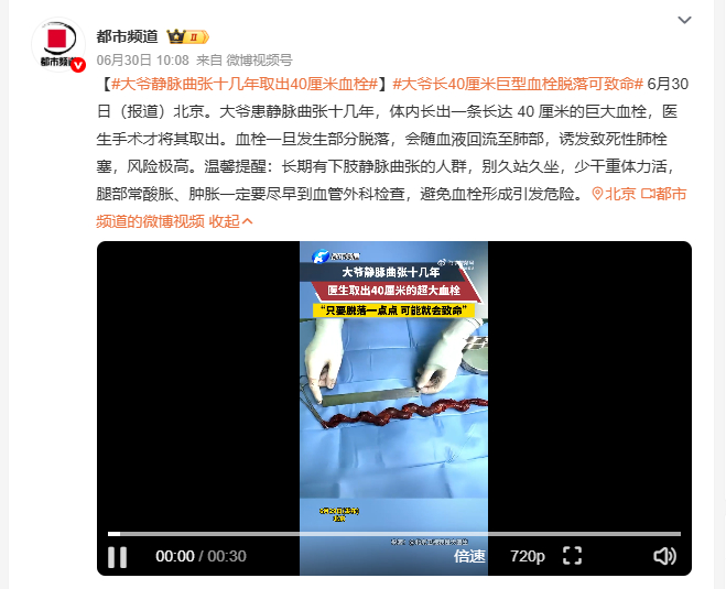 大爷静脉曲张十几年取出40厘米血栓 6月30日北京，一位老人患有静脉曲张长达十几