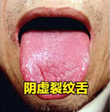 裂纹舌的三种类型，看看你是哪一种情况？

①阴虚 引起 裂纹舌
阴虚，体内津液不