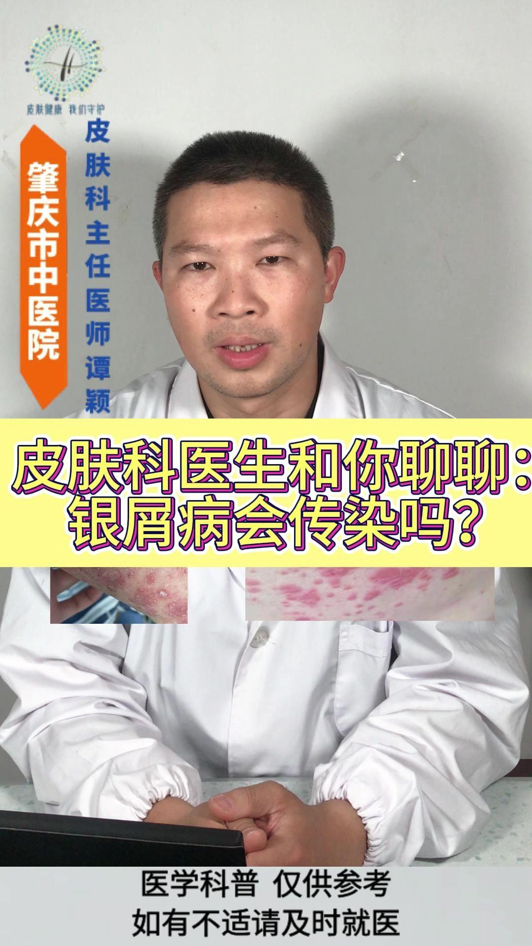 银屑病会传染吗？有些银屑病的患者来就诊的时候,常会担心这个银屑病是否会有传染性。