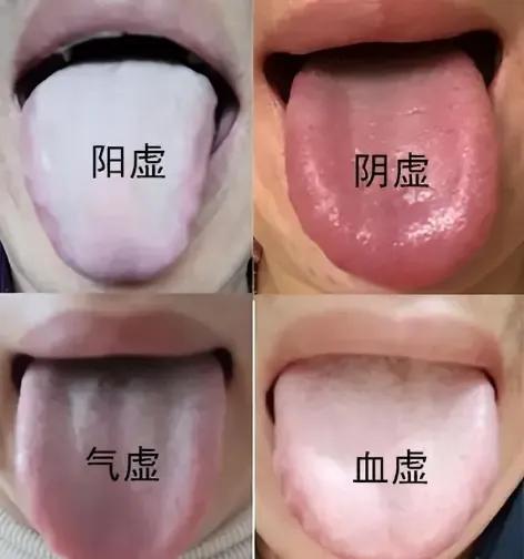 一分钟简单分辨四大虚，让你快速了解身体情况！阳虚、阴虚、气虚、血虚，你知道自己属