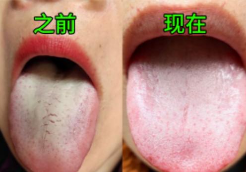 患者反馈：脾胃虚弱 调理好了，我们来看她舌象前后对比
之前：舌苔白腻很厚，平时肚
