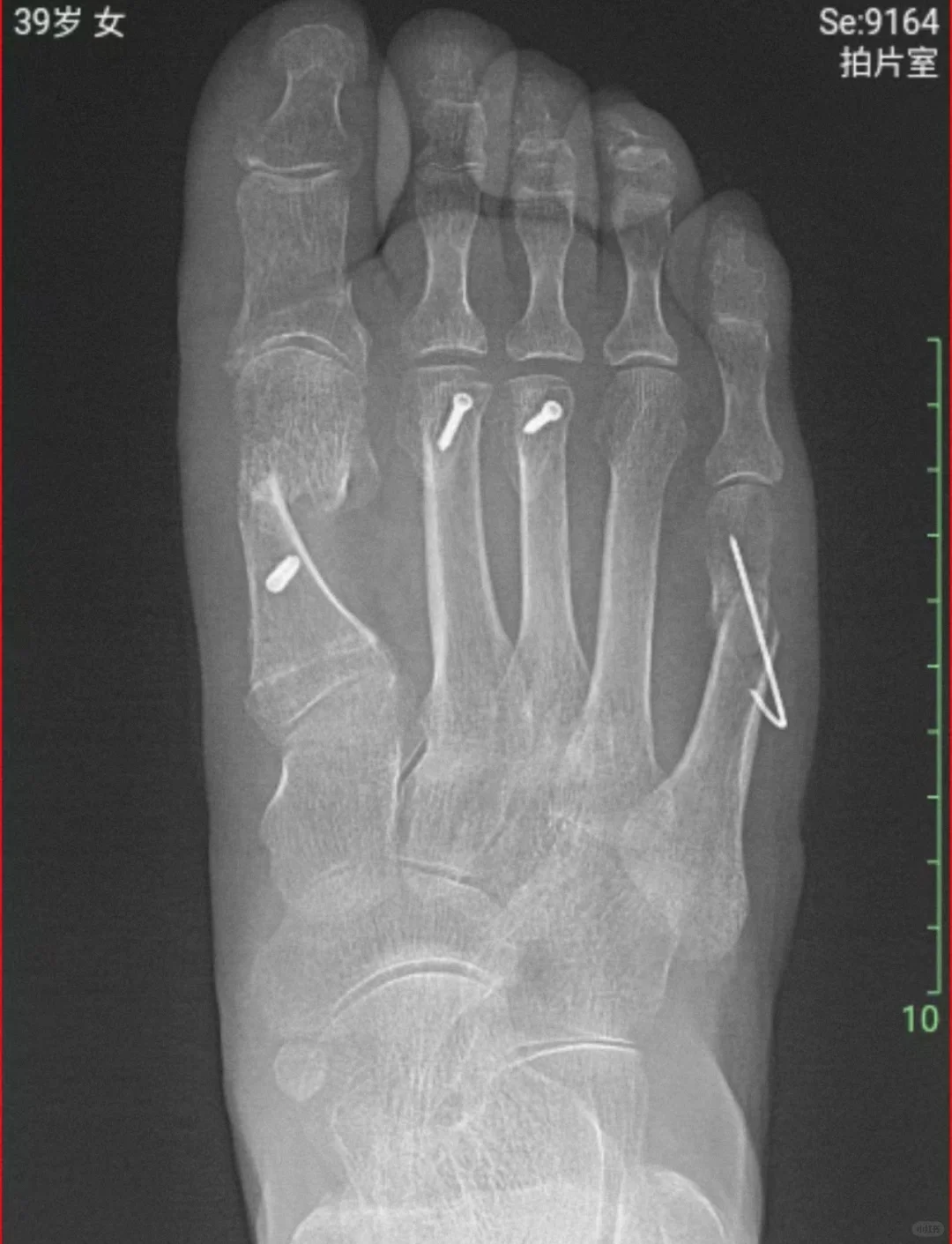 拇外翻术后X片