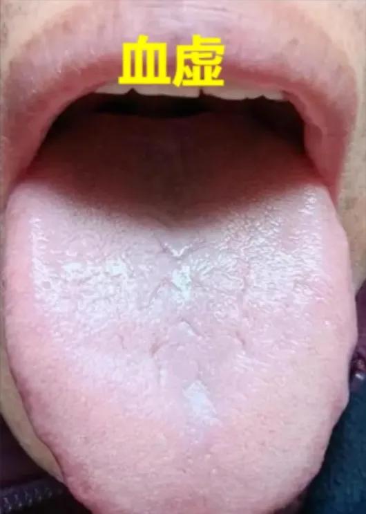 中医讲：舌头有裂纹，一定要注意，这是身体向你发出的求救信号！
 
1. 肝血虚