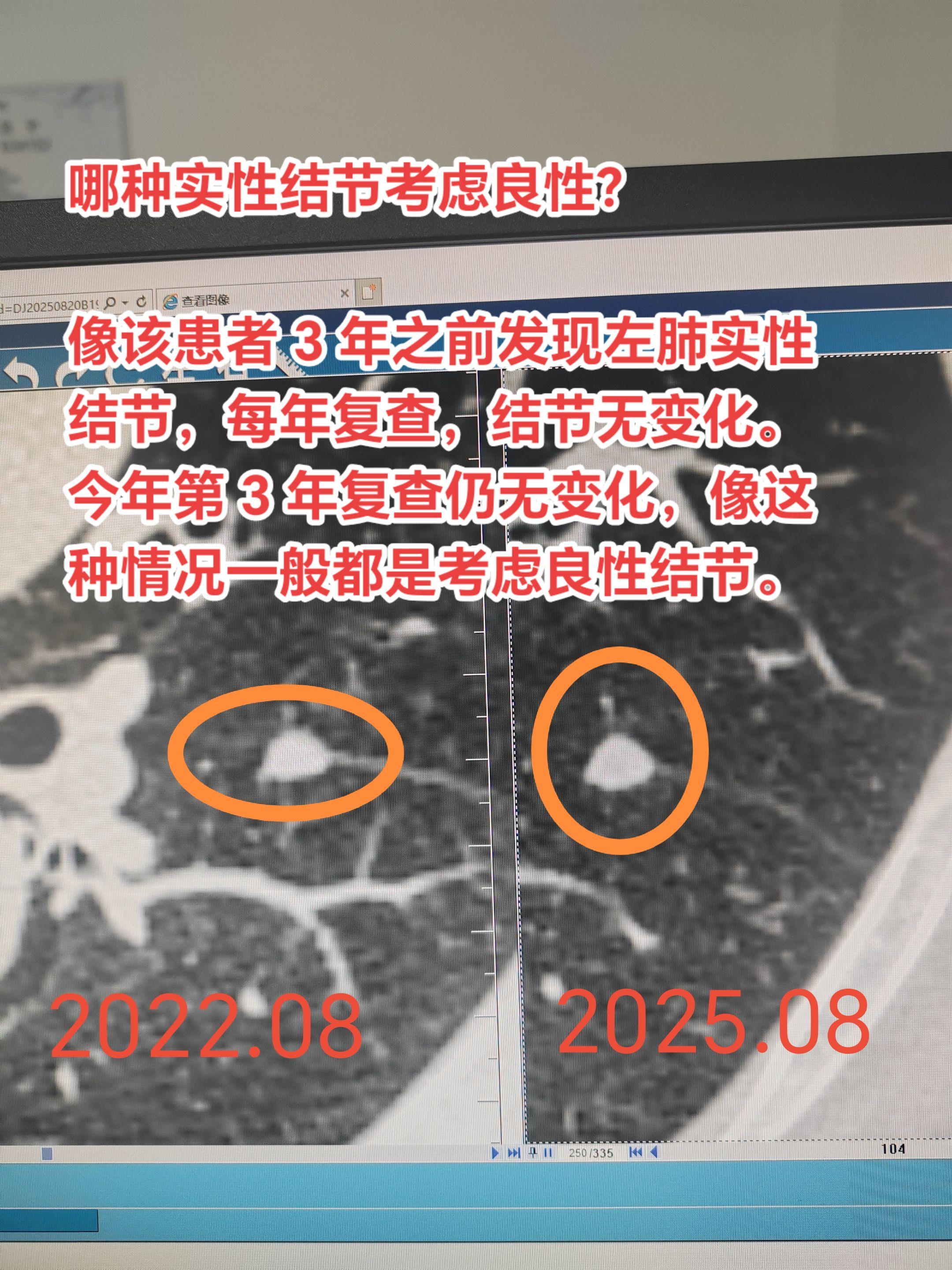 哪种肺实性结节考虑良性？像该患者 3 年之前发现左肺实性结节，每年复查...