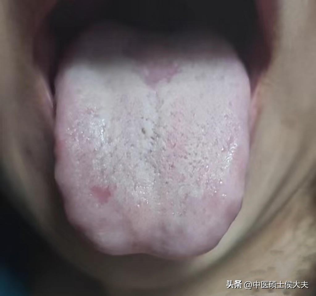 体内有寒又有热，这种寒热交杂舌象，调理起来才最费劲！[摊手]

患者主诉：最头疼