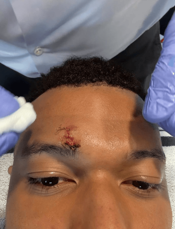 上轮西甲遭肘击流血，姆巴佩社媒晒出自己眉骨缝针的照片