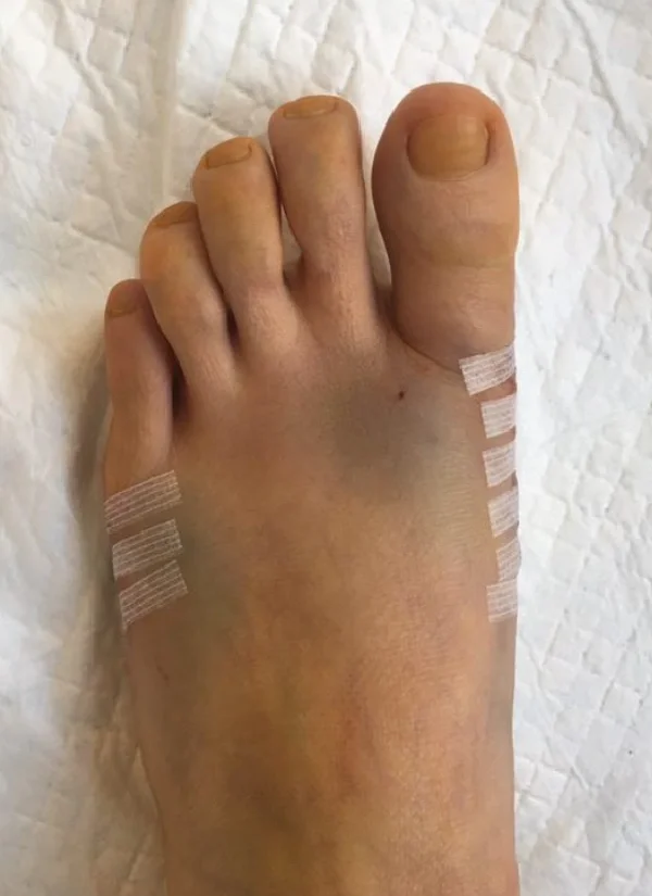 如何把拇外翻手术做好？