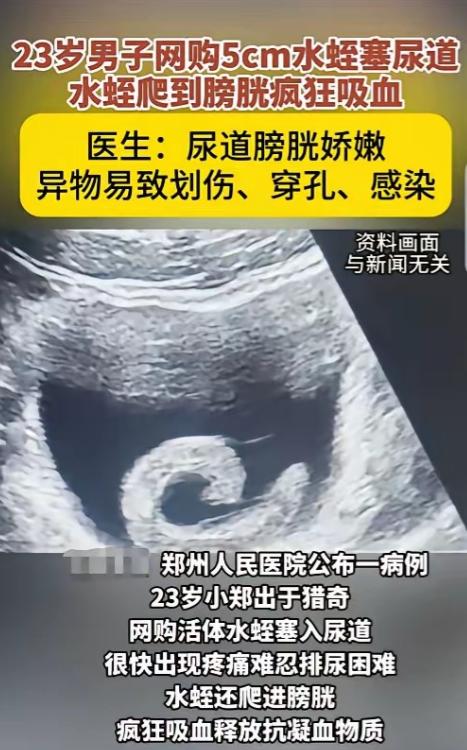 河南郑州 ，23 岁小伙听信偏方，网购一条5cm水蛭塞进尿道，谁料，虫子钻进膀胱